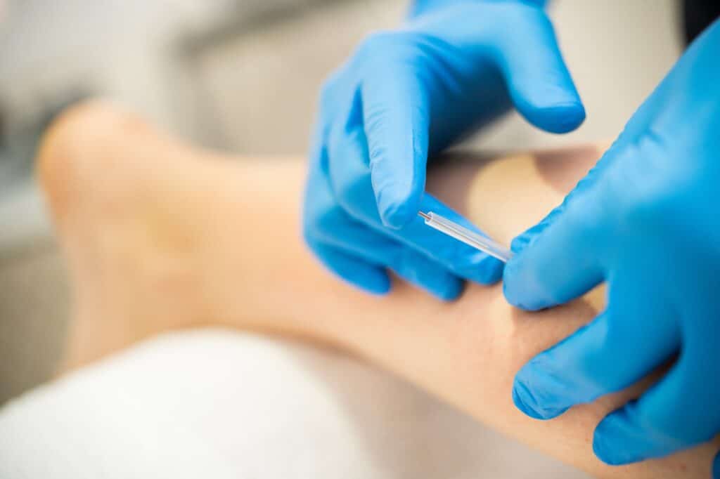 Hands of physiotherapist doing a dry needling