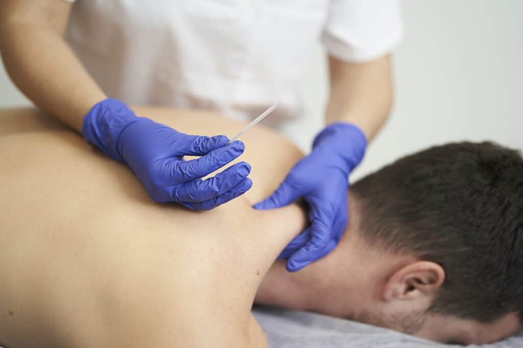 physiotherapist treating an overload with dry needling